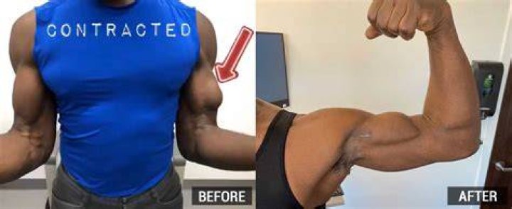Does a torn bicep require surgery?