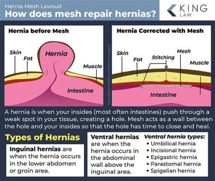 Does Medicare cover hernia repair?