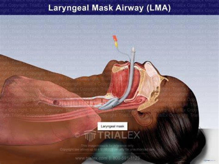 How does a LMA work?