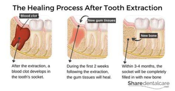 How long does it take for bone to heal after tooth extraction?