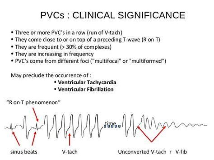 How many PVCs are considered v tach?