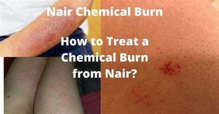 Is Nair supposed to burn?