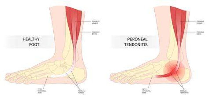 Is some tendonitis permanent?