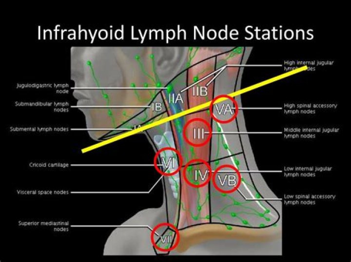 What is a shotty lymph node?