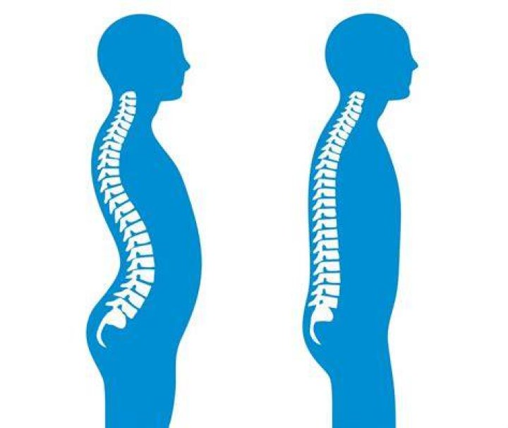 What is lumbar lordosis is reduced?