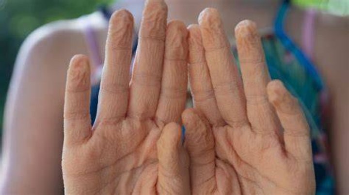 Why do my hands get wrinkly in water so fast?